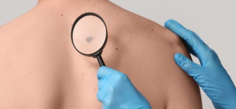 Clicca per accedere all'articolo Evento ECM:  MELANOMA: IL PERCORSO MULTIDISCIPLINARE DALLA DIAGNOSI ALLA TERAPIA
